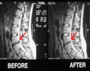 MRI pre and post spinal decompression treatment for low back pain